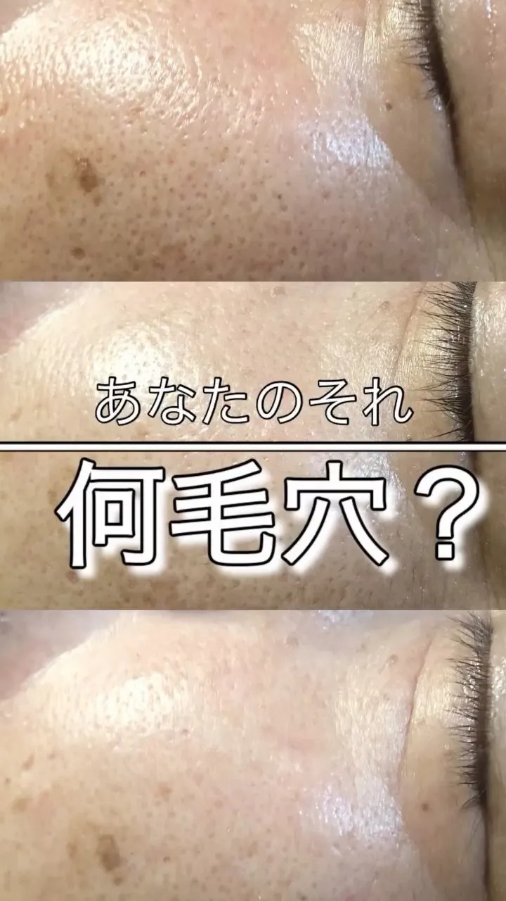 ＼気になる毛穴、何毛穴？／