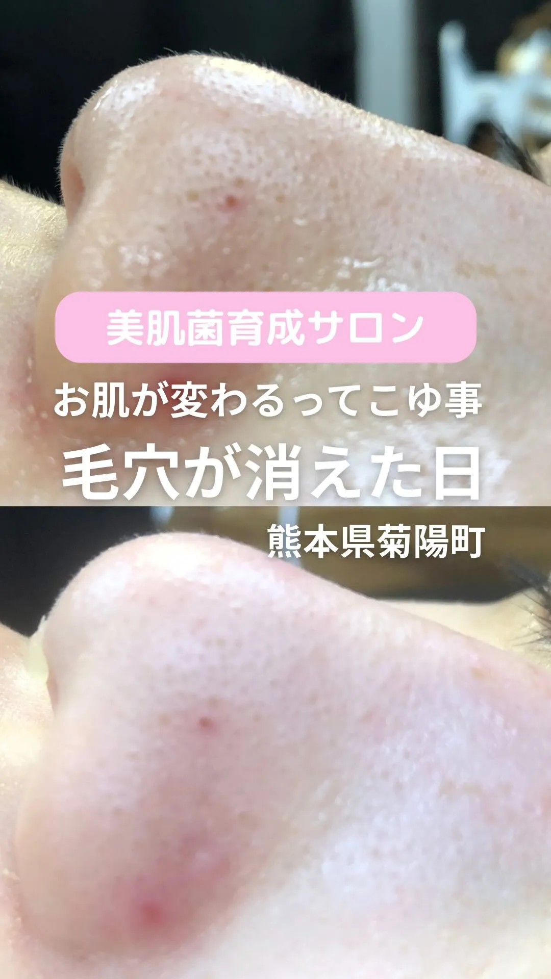 ＼毛穴が消えた日／