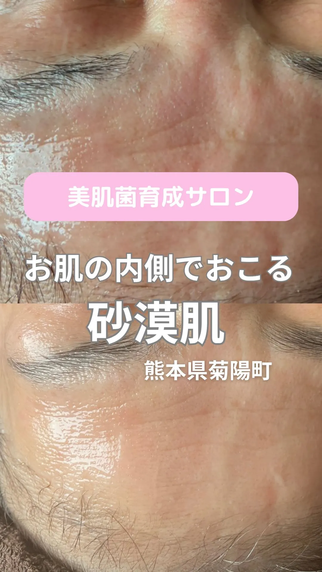 ＼お肌の内側におこる砂漠肌／