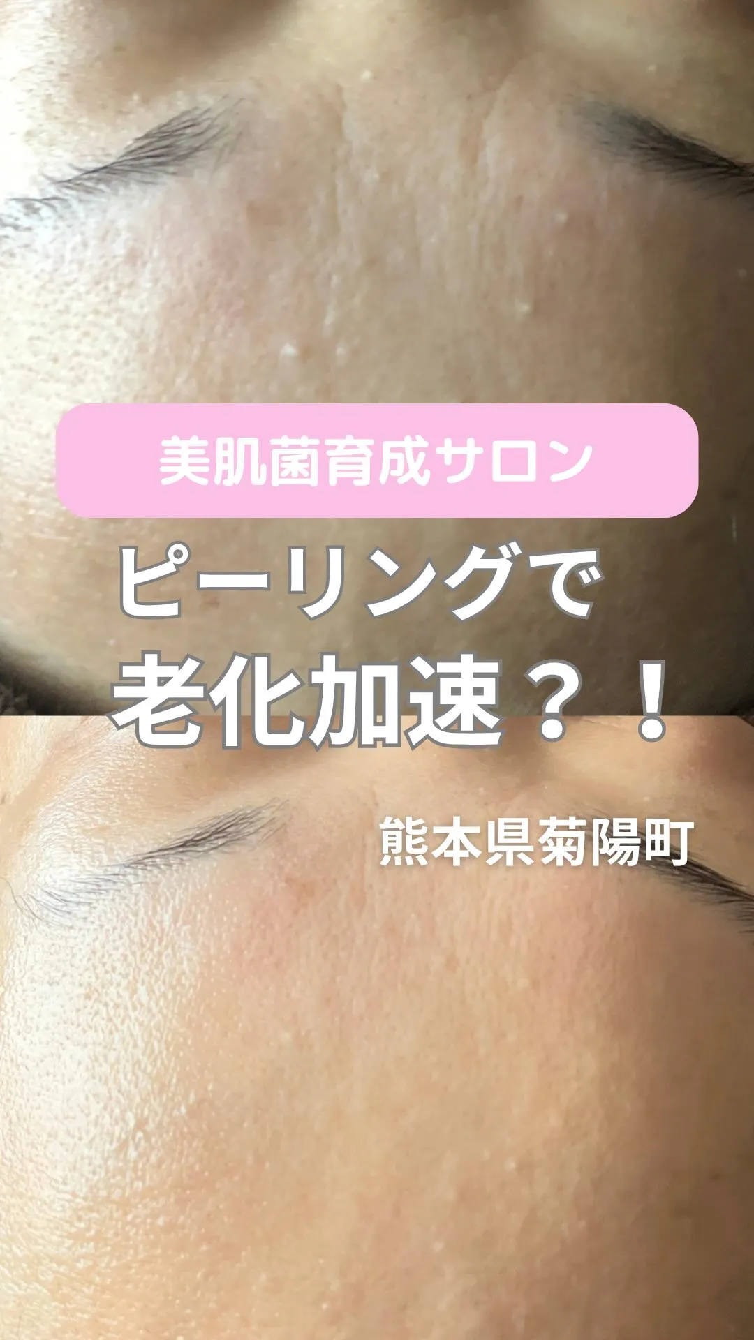 ＼ピーリングで老化加速／