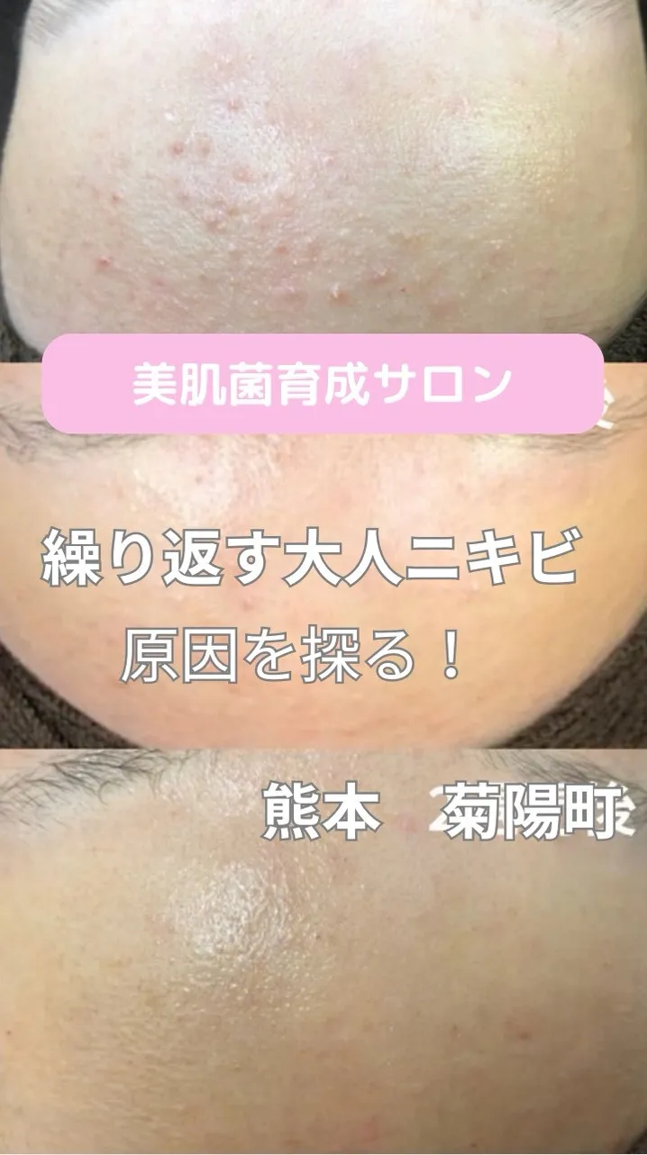 ＼ニキビの温床撃退／