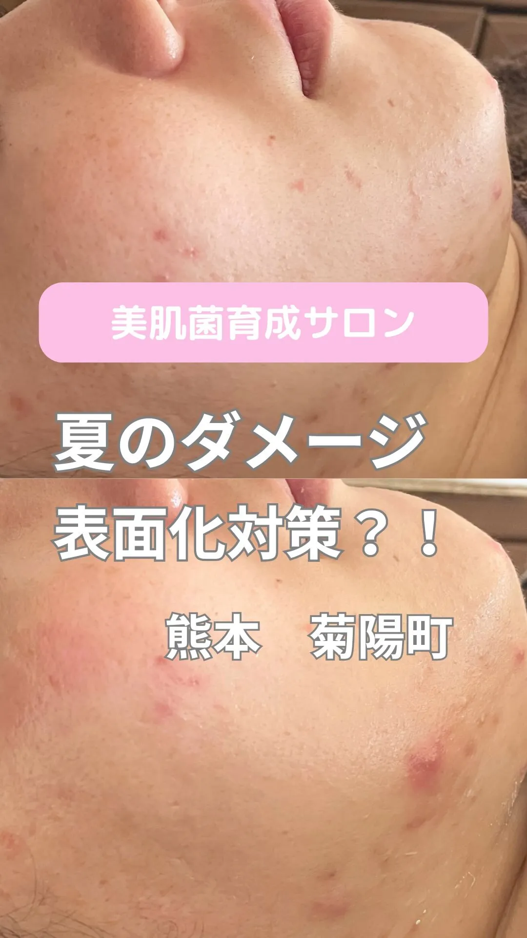 ＼夏のダメージが表面化／