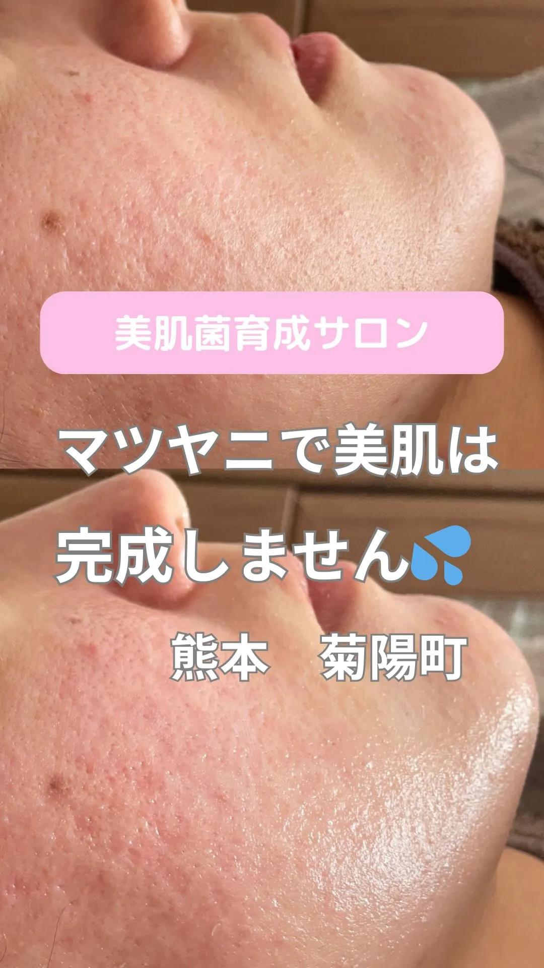 ＼マツヤニだけじゃ、美肌は完成しません⚠️／