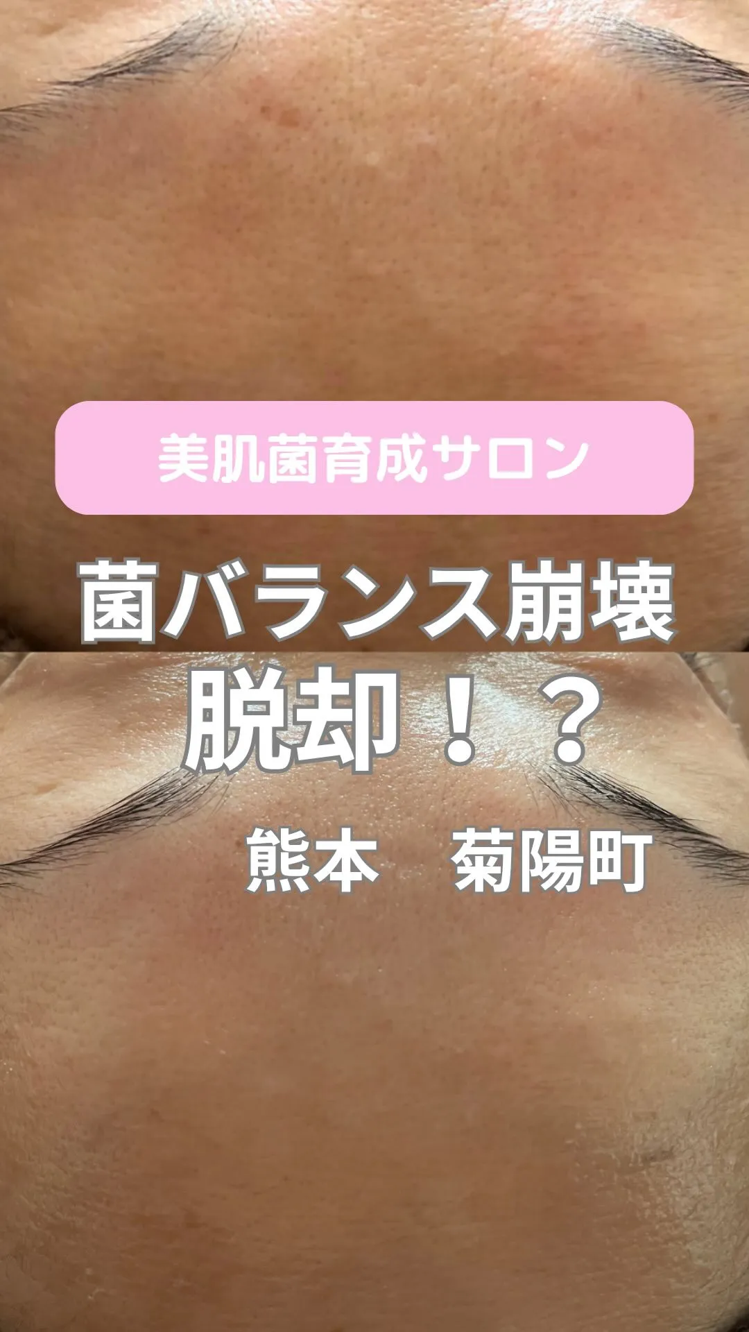 ＼菌バランス崩壊脱却／