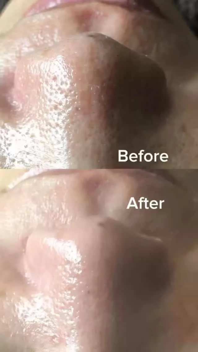 ＼毛穴トラブルに終止符／