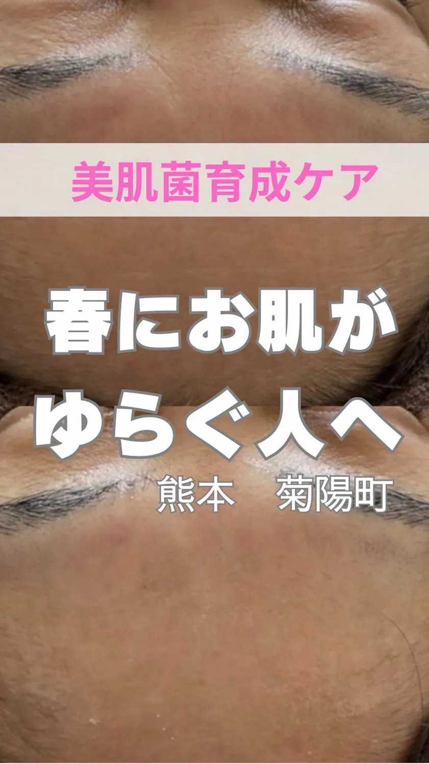 ＼春に肌荒れする人へ／