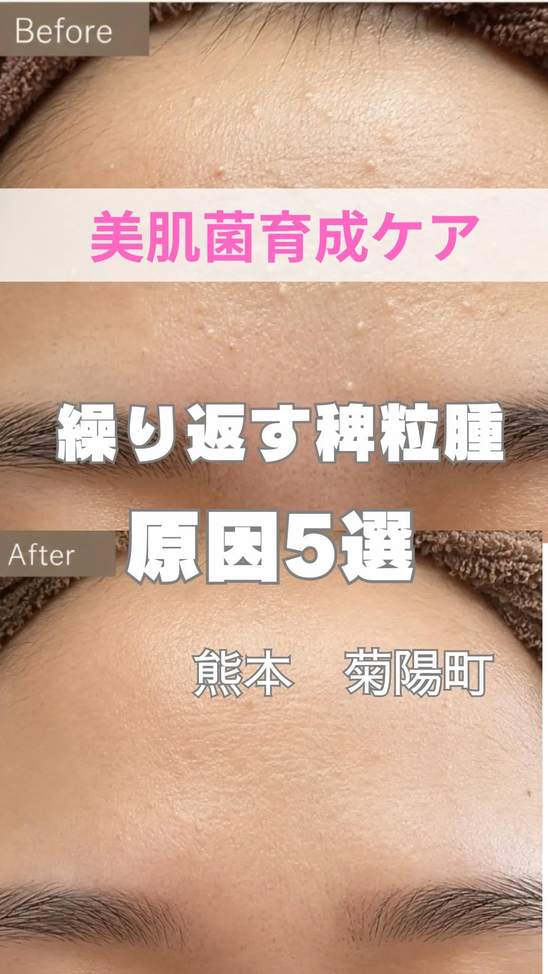 ＼繰り返す稗粒腫原因5選／
