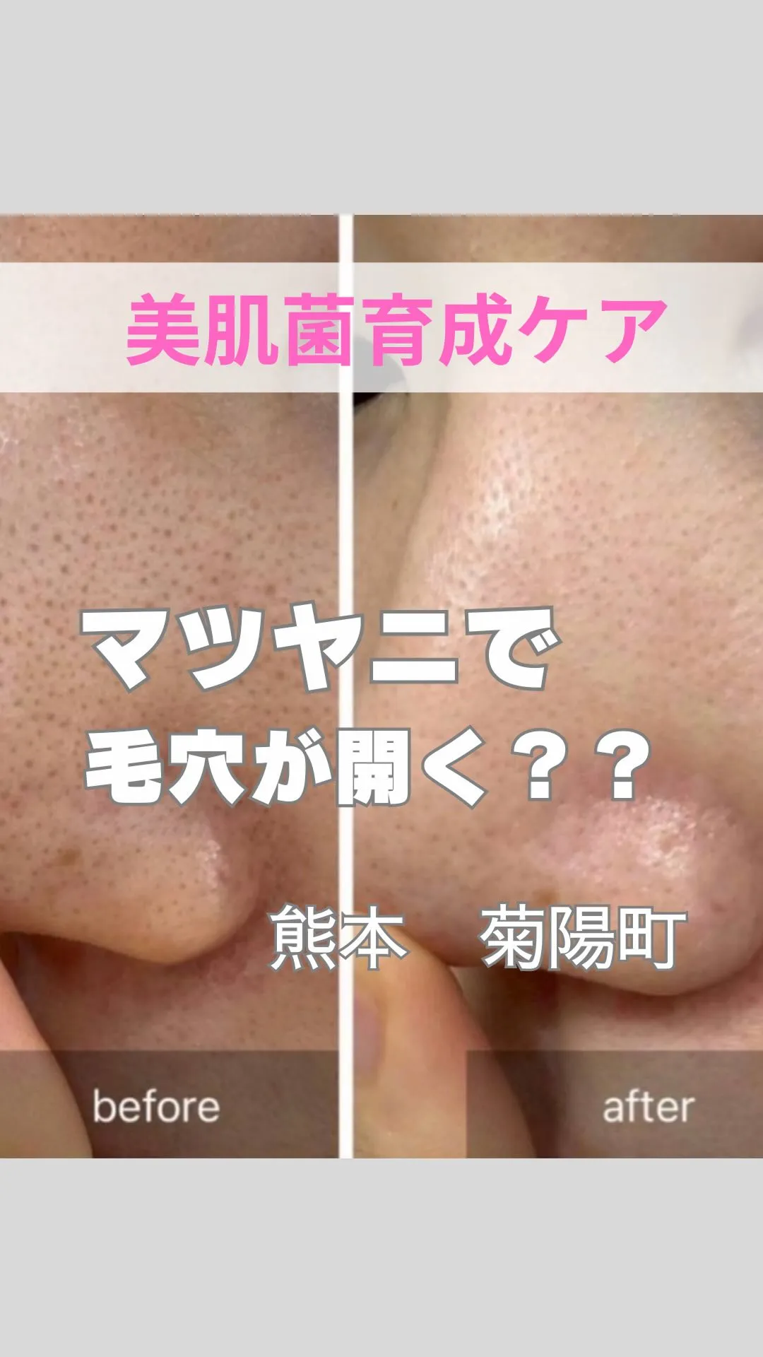 ＼マツヤニで毛穴が開く？／